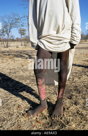 Junge mit Verbrennungen an seinen Beinen ins Feuer fallen. Simbabwe, Afrika Stockfoto