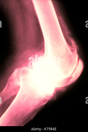 Farbige X-Ray zeigt arthritischen Knie Stockfoto