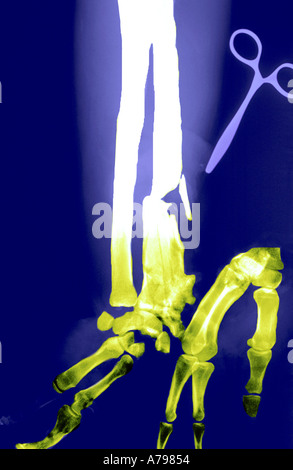 Farbige X-Ray mit gebrochenen Radius mit chirurgischen Instrumenten Stockfoto