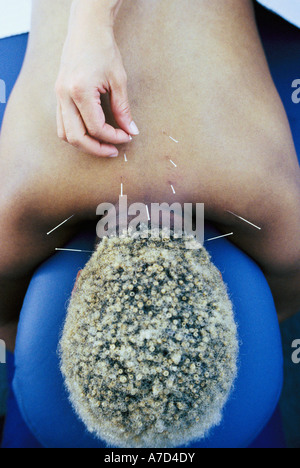 Akupunktur Nadeln zuweisen Patienten Nacken und Schultern Stockfoto