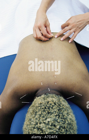 Akupunkteur Applyiing Nadeln auf Nacken, Schultern und Rücken Patienten Stockfoto