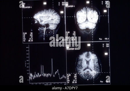 X-ray Krankenhaus "Magnetic Image" "Gehirn-Scan" medizinische Bild Kopf s/w Negative Bild "Medizintechnik" Stockfoto