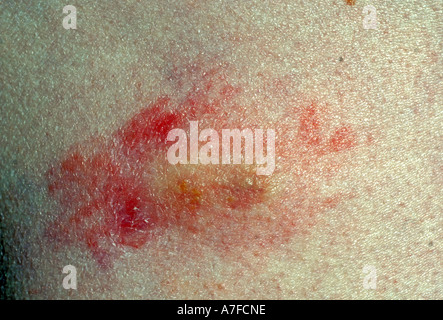 Herpes Zoster Gürtelrose Hautausschlag Stockfoto