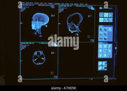 Ägypten, CT-Scan des Tutanchamun Stockfoto