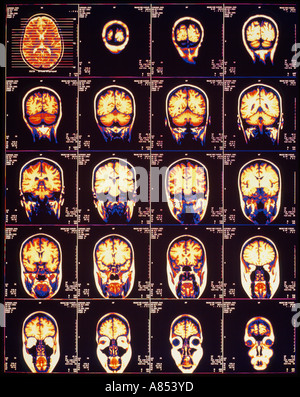Mehrere diagnostische Bilder des menschlichen Gehirns. Stockfoto