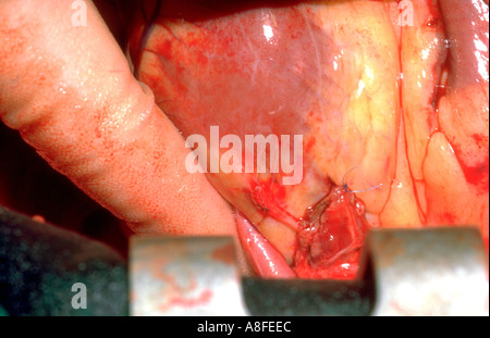 Coronary Artery Bypass Graft Betrieb Stockfoto