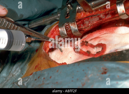 Coronary Artery Bypass Graft Verfahren Stockfoto