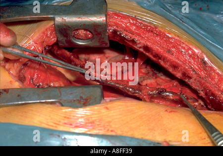 Coronary Artery Bypass Graft Verfahren Sternotomie Stockfoto