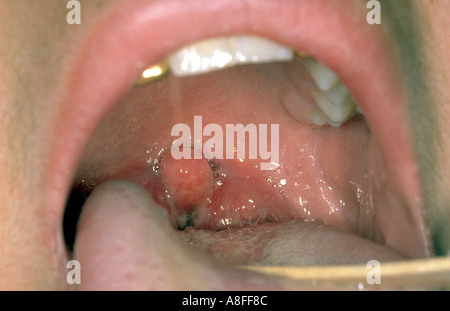 Faucial Diphtherie Stockfoto