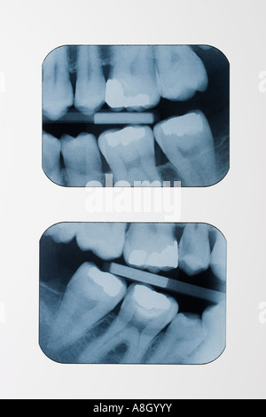 Dental Röntgenstrahlen Röntgenaufnahmen auf Leuchtkasten zeigt Füllungen und Filmträger Stockfoto