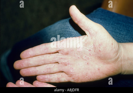 Pustulosis Palmaris, Psoriasis auf der Handfläche eines Patienten. Stockfoto