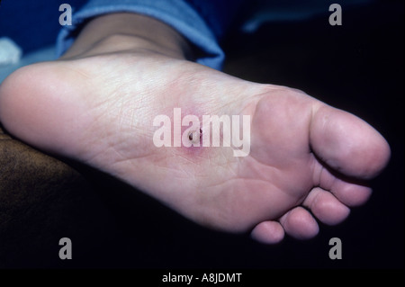 Patient mit häufige Hautkrankheit, die durch ein Virus verursacht. Stockfoto