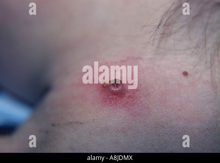 Patient mit häufige Hautkrankheit, die durch ein Virus verursacht. Stockfoto