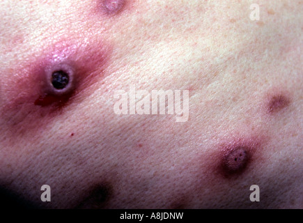 Patienten mit schmerzhaften Herpes Zoster Varizellen Ausschlag. Auch bekannt als Gürtelrose Pox Virus. Stockfoto