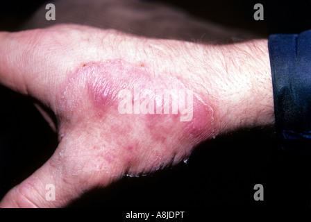 Pilzartige Infektion Ausschlag (Tinea) an Hand des Patienten. Stockfoto