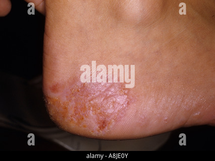 Kontakt Dermatitis (Ekzem) auf Patientenfußes und heilen Bereich. Stockfoto