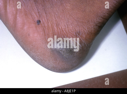 Kontakt Dermatitis (Ekzem) auf Patientenfußes und heilen Bereich. Stockfoto