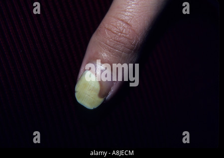 Kontaktdermatitis betroffen Nagel. Ekzematösen am Finger. Stockfoto