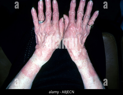 Kontaktdermatitis auf der Seite Eczematous. Stockfoto