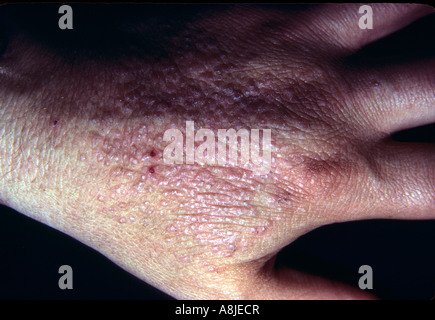 Kontaktdermatitis auf der Seite Eczematous. Stockfoto