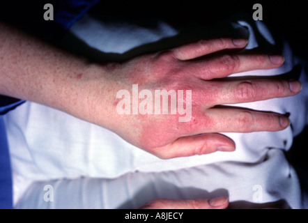 Kontaktdermatitis auf der Seite. Ekzematösen. Stockfoto