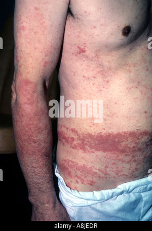 Kontaktdermatitis auf Körper des Patienten durch seine Kleider sind zu eng. Stockfoto