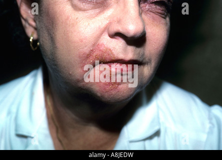 Kontakt Dermatitis im Gesicht des Patienten durch eine allergische Reaktion auf Kosmetik. Stockfoto