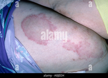 Allergische Kontaktekzem (Dermatitis) Ausschlag auf das Bein des Patienten. Stockfoto