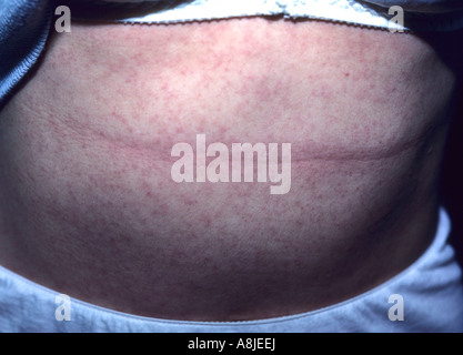 Allergische Kontaktekzem (Dermatitis) Ausschlag am Bauch des Patienten. Stockfoto