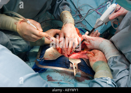 Chirurgen Bauchchirurgie Krebs Operation OP-Saal Stockfoto