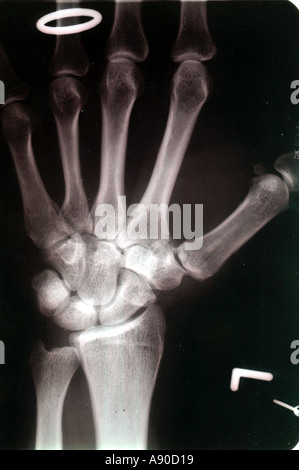 X-Ray von der linken Hand ein vierzig Jahre alter Mann zeigt Luxation Luxation des Daumens Stockfoto