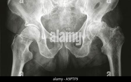 X-Ray Arthrose des Hüftgelenks Stockfoto