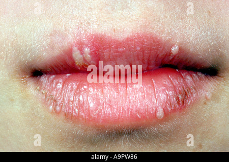 Herpes Simplex Fieberbl Schen Auf Lippen Und Gesicht Stockfotografie