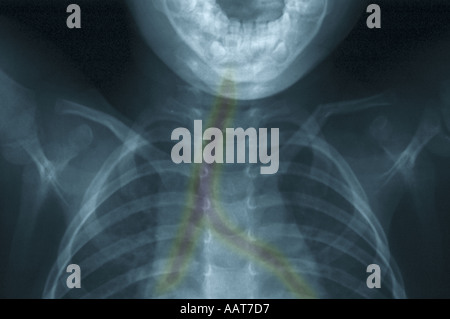 eingefärbte Xray zeigt gebrochenen Schlüsselbein Stockfoto