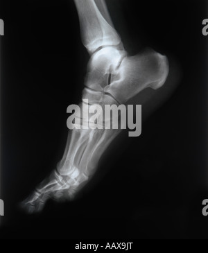 Fuß und Zehen Verletzung Röntgen-Scan Orthopädie und Traumatologie ...