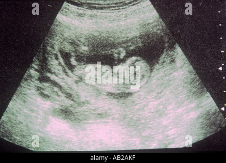 Ultraschalluntersuchung der weiblichen Fötus im Mutterleib Gesundheit Lifestyle Wales Stockfoto