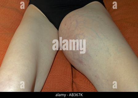 Hohe Klasse Soft Tissue Sarkom auf der linken Innenseite des Oberschenkels in ihren 30ern / 40er Jahre Stockfoto