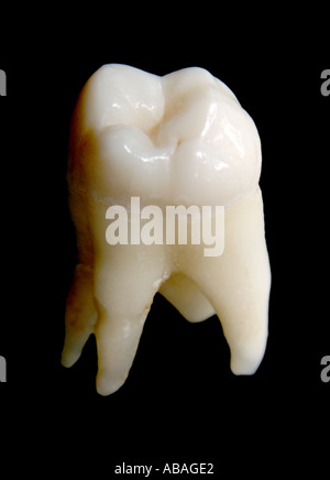 Weisheitszahn von weit hinten im Oberkiefer, gezogen von einem Zahnarzt Stockfoto