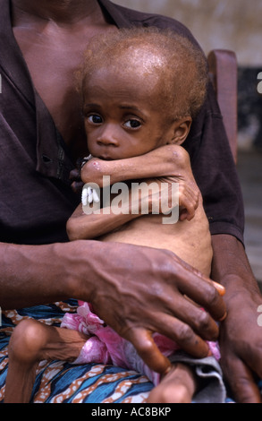 Sierra Leone 1999 Opfer des Krieges schwer unterernährte baby Stockfoto