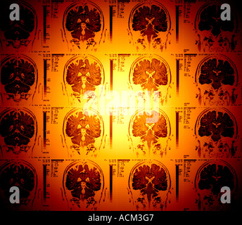 farbige Röntgenbilder der Großhirnrinde Kleinhirn menschliche Gehirn MRI Stockfoto