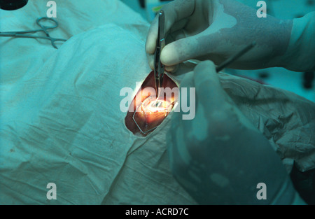 Kataraktoperation zu Bangladesch Krankenhaus Boot namens Jibon Tori. Stockfoto