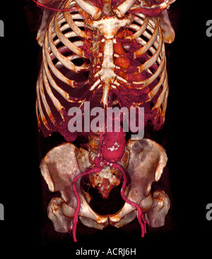 3D CT-Scan ein 79 Jahre alter Mann mit einer abdominalen Aortenaneurysma von ca. 6 cm Stockfoto