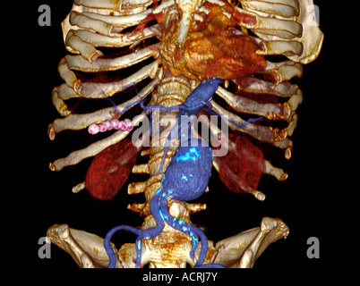 3D CT-Scan ein 79 Jahre alter Mann mit einer abdominalen Aortenaneurysma von ca. 6 cm Stockfoto