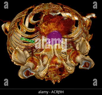3D CT-Scan ein 79 Jahre alter Mann mit einer abdominalen Aortenaneurysma Abmessungen ca. 6 cm, Ansicht von unten bis in den Bauch Stockfoto
