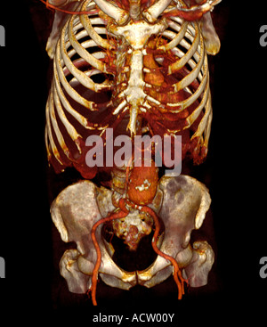 3D CT-Scan ein 79 Jahre alter Mann mit einer abdominalen Aortenaneurysma von ca. 6 cm Stockfoto