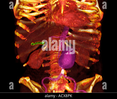 3D CT-Scan ein 79 Jahre alter Mann mit einer abdominalen Aortenaneurysma dargestellt in violett Stockfoto