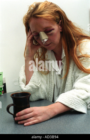 Frau, die Opfer von häuslicher Gewalt mit mehreren Prellungen und eine gebrochene Nase geworden ist. Stockfoto