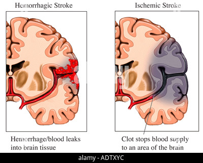 Hämorrhagischer Schlaganfall Stockfoto, Bild: 84398572 - Alamy