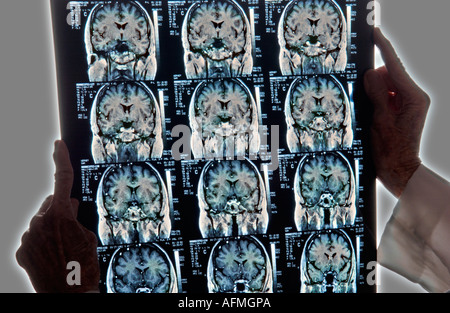 Arzt Untersuchung Röntgenstrahlen der Großhirnrinde Kleinhirn menschliche Gehirn Stockfoto