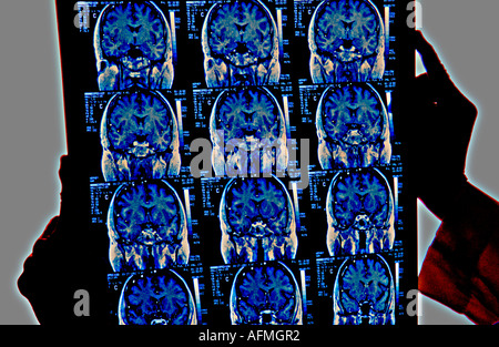 Arzt Untersuchung Röntgenstrahlen der Großhirnrinde Kleinhirn menschliche Gehirn Stockfoto